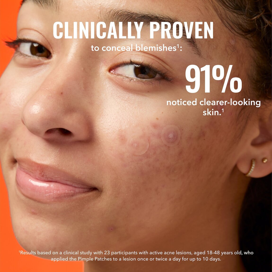 pimple-patches-y1 zb_p.jpg