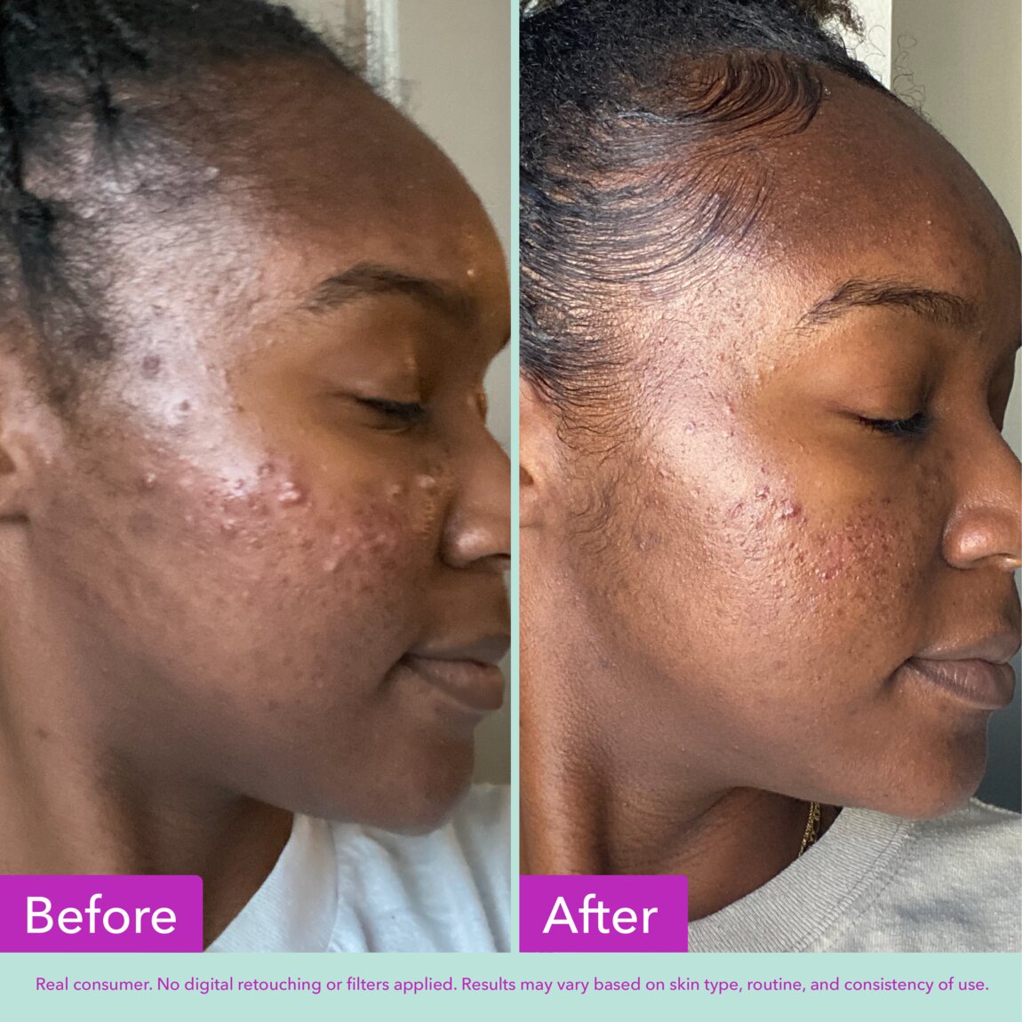 acne-foaming-cleanser-z3 zb_p.jpg